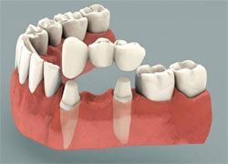 Физиологичные зубные протезы
